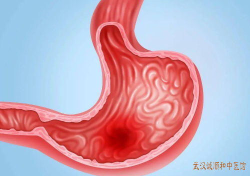 胃溃疡胃痛伴稀便中医怎么治疗？