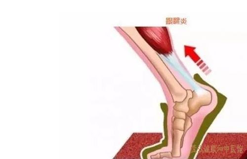 湖北针灸厉害的柳新樵中医：右足跟疼痛半年多跟腱炎中医能不能治?