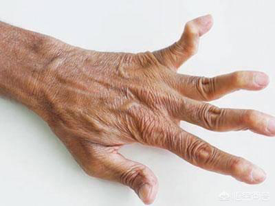 类风湿性关节炎手部症图片