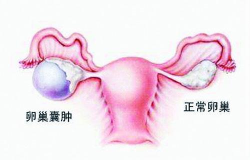 中医对卵巢囊肿如何认识？