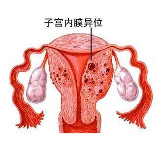 中医如何治疗子宫内膜异位症?