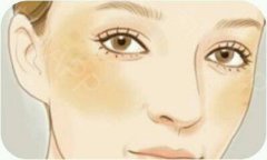 黄褐斑影响容貌美观，中医治疗这种皮肤病效果好吗？