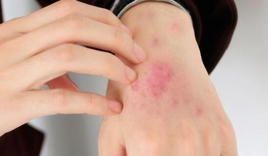 身体出现这6种瘙痒症状的，可能是荨麻疹在作怪
