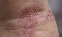 皮肤瘙痒症快速止痒的治疗方法，中医祛风止痒内服外用!