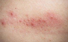 斑丘疹皮损发红且奇痒因搔抓而继发感染，中医讲述其病因病机和疗法