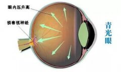 青光眼导致视野缺损及视力下降，中医指导该眼病的预防及保健
