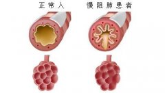 李轩锦：中医可以治疗中度慢阻肺吗？