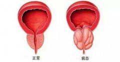徐长化：老人前列腺增生尿不尽中医能治好吗？