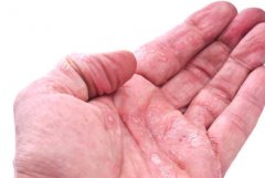 手上长湿疹的图片介绍，皮肤科中医范平教授教你识别手部湿疹
