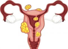 廉河清中医：子宫肌瘤吃什么中药能消除？