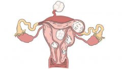 子宫肌瘤中医怎么治疗？白带增多，月经有血块，经行腹痛腰酸需警惕