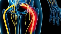 坐骨神经痛引发臀部放射性窜痛吃什么中药方子治疗效果好？