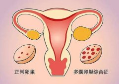 武汉不孕不育医院知名专家姜瑞雪教授：多囊卵巢综合症月经量少不孕6年怎
