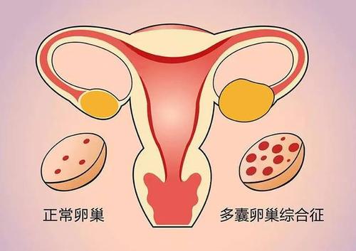 多囊卵巢综合症月经延迟3年不孕吃什么中药能治好