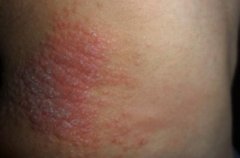 双手侧端突发神经性皮炎1个月皮肤剧烈瘙痒初期怎么治疗可以较快好转？