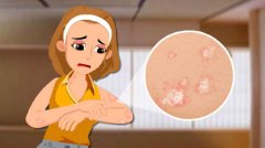 中医皮肤病专家胡爱玲：银屑病起红疹鳞屑伴瘙痒怎么治疗吃什么药有效？
