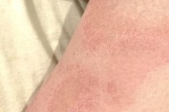 名老中医胡爱玲：慢性湿疹左小腿前侧皮肤粗糙增厚瘙痒10年反复发作怎么