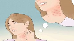慢性湿疹反复起红丘疹，瘙痒抓挠后有渗出液中医治疗吃什么药效果好？