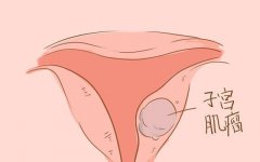月经量增多经期异常是妇科疾病吗？子宫肌瘤中医有什么好的治疗方法？