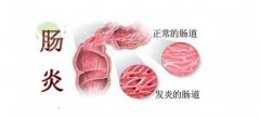 武汉名中医刘玉茂：反复肠鸣泄泻并左下腹隐痛2年多，慢性肠炎中医治疗效