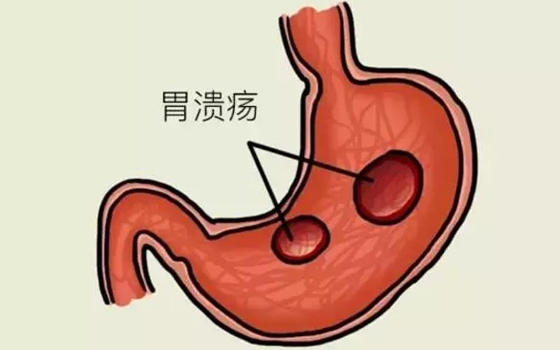 胃溃疡有哪些症状？