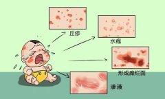 急性湿疹起红斑丘疹水疱、形成糜烂面渗液剧烈瘙痒中医如何辨证论治？