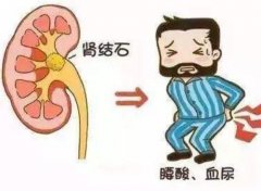 汉阳中医男科专家门诊王垚：左肾结石血尿伴腰痛胀稍一活动就加重身困乏