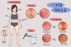 武汉中医治疗湿疹的皮肤病专家胡爱玲：顽固性湿疹病情反复发展怎么办？