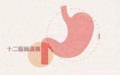 腹部疼痛胃灼热打嗝，广州武汉总医院退休专家刘玉茂：十二指肠溃疡中医