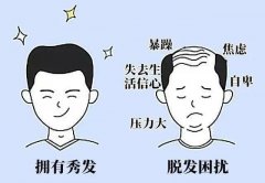 武汉治疗脱发厉害的老中医胡爱玲：男性型脱发会秃顶吗有什么方法调理？