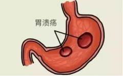武汉治疗胃病老专家张林茂：胃溃疡餐后腹胀不适伴周期性腹痛怎么办？
