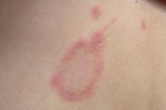 皮肤科中医胡爱玲：玫瑰糠疹身上起环形红色皮疹有薄鳞屑怎么治疗见效快