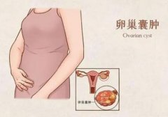 武汉中医妇科医院姜瑞雪教授：卵巢囊肿月经延期10天量少经前腹胀吃什么