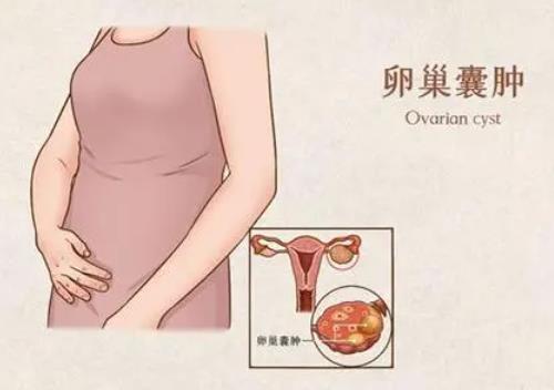 卵巢囊肿月经延期10天量少经前腹胀吃什么中药能治好？