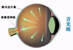 武汉眼科名老中医丁辛博士：青光眼2年，双眼发胀干涩，头重痛，怎么治疗