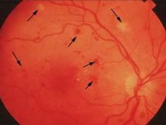 武汉眼科中医博士后丁辛：视力明显下降视野中有黑影是视网膜静脉周围炎
