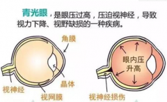 武汉眼科针灸专家丁辛：青光眼导致眼红胀痛视力下降中药针灸治疗怎么样