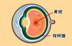 武汉眼病专家丁辛博士：视力下降把直的东西看成弯的是老年性黄斑病变吗