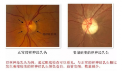 武汉眼科丁辛博士后：眼睛外伤导致视神经萎缩看东西不清楚中医怎么治疗