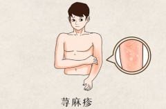 武汉皮肤科中医胡爱玲：荨麻疹不定期发作全身瘙痒散发凸起成片怎么办？