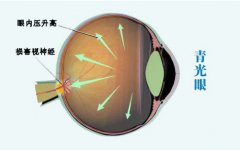 武汉青光眼丁辛博士：眼睛混浊不能视物涩痛流泪中医有哪些治疗方式？