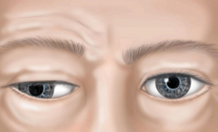 武汉眼科丁辛博士后：眼肌麻痹上睑下垂眼球活动受限中医针灸能治疗吗？