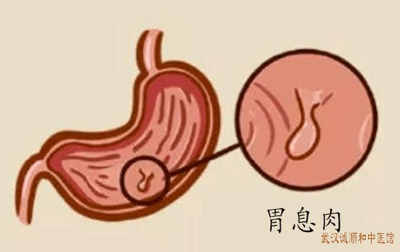 胃息肉术后调理医案一则