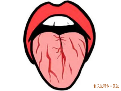 裂纹舌中医怎么辨证治疗?