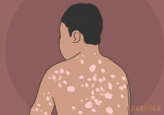 皮肤科中医胡爱玲：银屑病全身泛发红斑鳞屑有什么有效的辨证治疗方式？