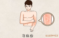 潜江中医胡爱玲：荨麻疹刺激后明显皮肤瘙痒有抓痕交错喝中药治疗有用吗