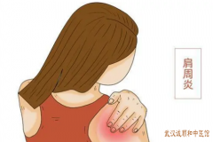中医骨伤科有名的专家孔政：肩周疼痛受凉及劳累后加重肩周炎怎么治？