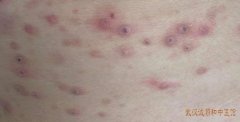 结节性痒疹到底是什么因素导致？中医中药有哪些方式治疗皮肤性结节损害