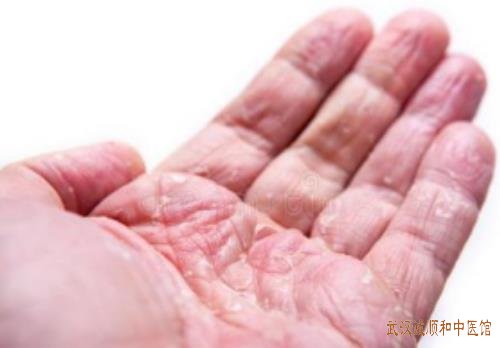 手部起水泡瘙痒有红斑丘疹病情反复不愈是什么原因？中医怎么治疗手部湿疹？