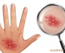 武汉有名的皮肤科主任王儒英：中医治疗银屑病内外兼治好转医案一则。